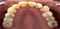 Upper Back Teeth Restored with Dental Implants and Screw Retained Crowns - After