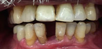 Restored Front Lower Tooth Replaced With Dental Implant in Delhi