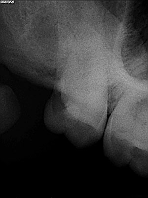 Root Canal Treatment @ New Delhi Dental Clinic